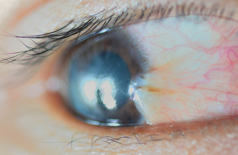 Pterygium_CloseUp